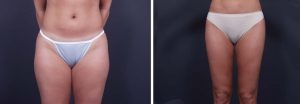 Liposuction Patient 5a | Dr. Shaun Parson Plastic Surgery Scottsdale Arizona