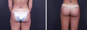 Liposuction Patient 5a | Dr. Shaun Parson Plastic Surgery Scottsdale Arizona