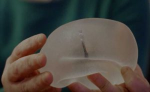Breast Revision Expert | Dr. Shaun Parson Plastic Surgery Scottsdale
