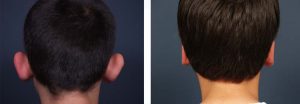 Otoplasty Patient 1 | Dr. Shaun Parson Plastic Surgery Scottsdale Arizona