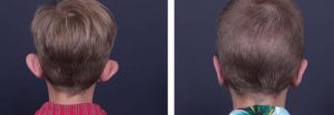 Otoplasty Patient 2 | Dr. Shaun Parson Plastic Surgery Scottsdale Arizona