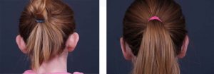 Otoplasty Patient 4 | Dr. Shaun Parson Plastic Surgery Scottsdale Arizona