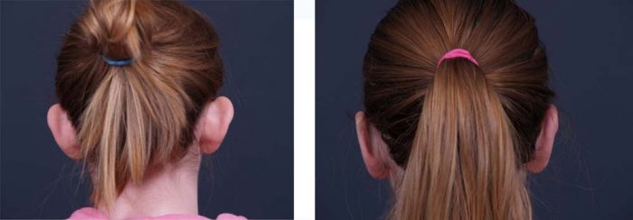 Otoplasty Patient 4 | Dr. Shaun Parson Plastic Surgery Scottsdale Arizona