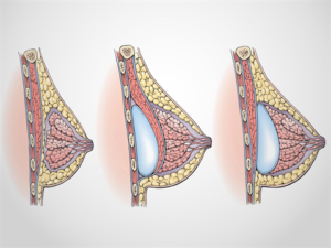 Breast Augmentation Implant Placement | Dr. Shaun Parson Plastic Surgery Scottsdale, AZ