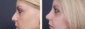 Rhinoplasty Patient 1a | Dr. Shaun Parson Plastic Surgery Scottsdale Arizona