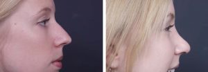 Rhinoplasty Patient 2a | Dr. Shaun Parson Plastic Surgery Scottsdale Arizona