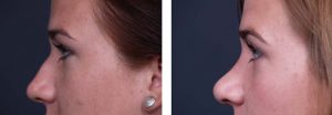 Rhinoplasty Patient 4a | Dr. Shaun Parson Plastic Surgery Scottsdale Arizona