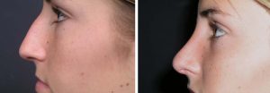 Rhinoplasty Patient 5a | Dr. Shaun Parson Plastic Surgery Scottsdale Arizona