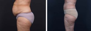 Tummy Tuck Patient 10a | Dr. Shaun Parson Plastic Surgery Scottsdale Arizona