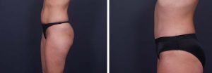 Tummy Tuck Patient 1a | Dr. Shaun Parson Plastic Surgery Scottsdale Arizona