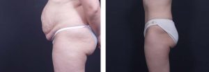 Tummy Tuck Patient 4a | Dr. Shaun Parson Plastic Surgery Scottsdale Arizona