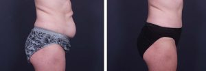 Tummy Tuck Patient 5a | Dr. Shaun Parson Plastic Surgery Scottsdale Arizona