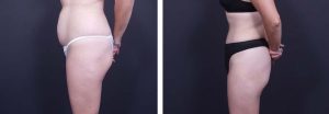 Tummy Tuck Patient 6a | Dr. Shaun Parson Plastic Surgery Scottsdale Arizona