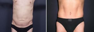 Tummy Tuck Patient 7a | Dr. Shaun Parson Plastic Surgery Scottsdale Arizona