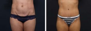 Tummy Tuck Patient 8a | Dr. Shaun Parson Plastic Surgery Scottsdale Arizona
