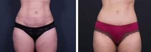 Tummy Tuck Patient 9a | Dr. Shaun Parson Plastic Surgery Scottsdale Arizona