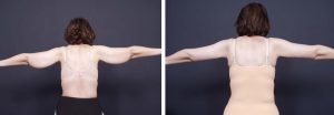 Arm Lift Surgery Photos | Dr. Shaun Parson Plastic Surgery Scottsdale Arizona