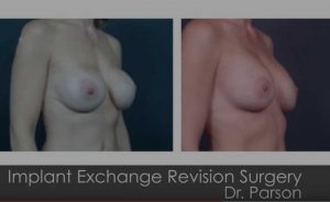 Breast Revision Expert | Dr. Shaun Parson Plastic Surgery Scottsdale