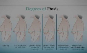 Breast Lift Mastopexy | Dr. Shaun Parson Plastic Surgery Scottsdale