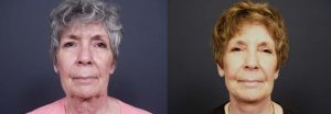 facelift patient 2a | Dr. Shaun Parson Plastic Surgery Scottsdale Arizona