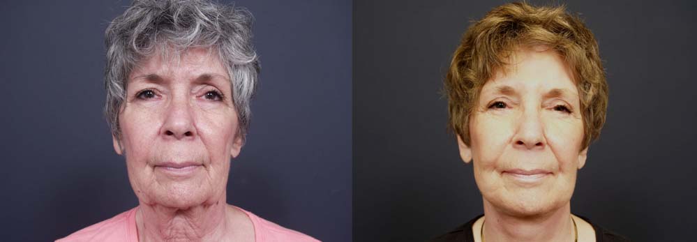 facelift patient 2a | Dr. Shaun Parson Plastic Surgery Scottsdale Arizona