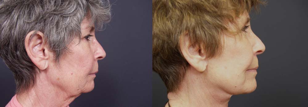 facelift patient 2a | Dr. Shaun Parson Plastic Surgery Scottsdale Arizona