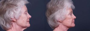 facelift patient 3a | Dr. Shaun Parson Plastic Surgery Scottsdale Arizona