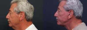 facelift patient 4a | Dr. Shaun Parson Plastic Surgery Scottsdale Arizona