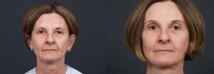 facelift patient 6a | Dr. Shaun Parson Plastic Surgery Scottsdale Arizona