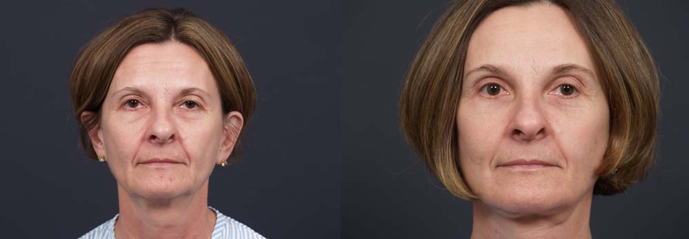 facelift patient 6a | Dr. Shaun Parson Plastic Surgery Scottsdale Arizona