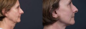 facelift patient 6a | Dr. Shaun Parson Plastic Surgery Scottsdale Arizona