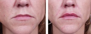 Dermal Filler Patient 3 | Dr. Shaun Parson Plastic Surgery Scottsdale Arizona