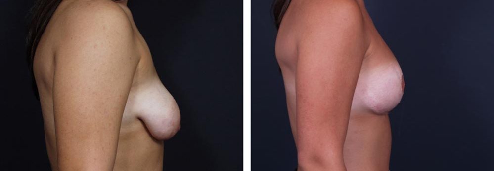Breast Revision Patient 3 | Dr. Shaun Parson Plastic Surgery, Scottsdale, Arizona