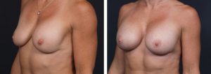 Breast Revision Patient 6 | Dr. Shaun Parson Plastic Surgery, Scottsdale, Arizona