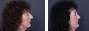 Rhinoplasty Patient 3 | Dr. Shaun Parson Plastic Surgery, Scottsdale, Arizona