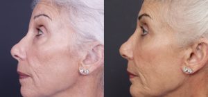 Chin Implant Patient 6 | Dr. Shaun Parson Plastic Surgery, Scottsdale, Arizona