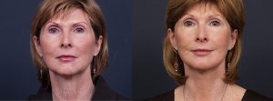 Facelift Patient 10 | Dr. Shaun Parson Plastic Surgery, Scottsdale, Arizona