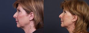 Facelift Patient 10 | Dr. Shaun Parson Plastic Surgery, Scottsdale, Arizona