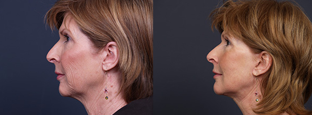 Facelift Patient 10 | Dr. Shaun Parson Plastic Surgery, Scottsdale, Arizona