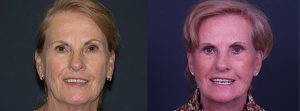 Facelift Patient 11 | Dr. Shaun Parson Plastic Surgery, Scottsdale, Arizona