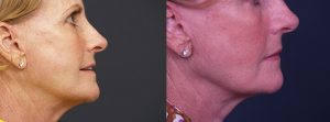 Facelift Patient 11 | Dr. Shaun Parson Plastic Surgery, Scottsdale, Arizona