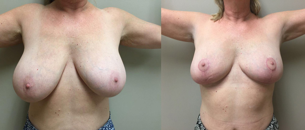 Breast Lift Patient 11 | Dr. Shaun Parson Plastic Surgery Scottsdale Arizona