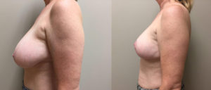 Breast Lift Patient 11 | Dr. Shaun Parson Plastic Surgery Scottsdale Arizona