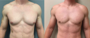 Gynecomastia Patient 8 | Dr. Shaun Parson Plastic Surgery Scottsdale Arizona
