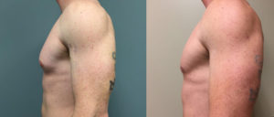 Gynecomastia Patient 8 | Dr. Shaun Parson Plastic Surgery Scottsdale Arizona