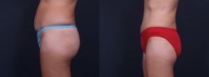 Tummy Tuck Patient 17 | Dr. Shaun Parson Plastic Surgery, Scottsdale, Arizona