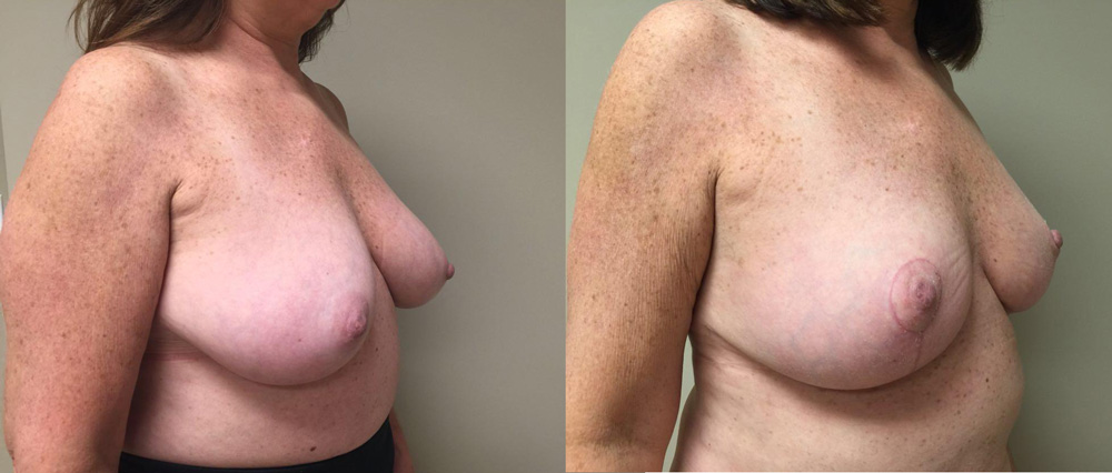 Breast Lift Patient 13 | Dr. Shaun Parson Plastic Surgery Scottsdale Arizona