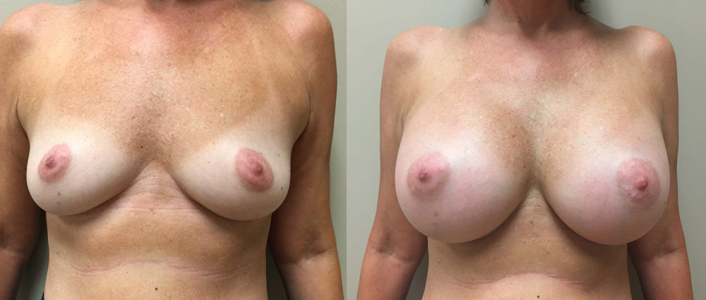 Breast Augmentation Patient 24 | Dr. Shaun Parson Plastic Surgery Scottsdale Arizona