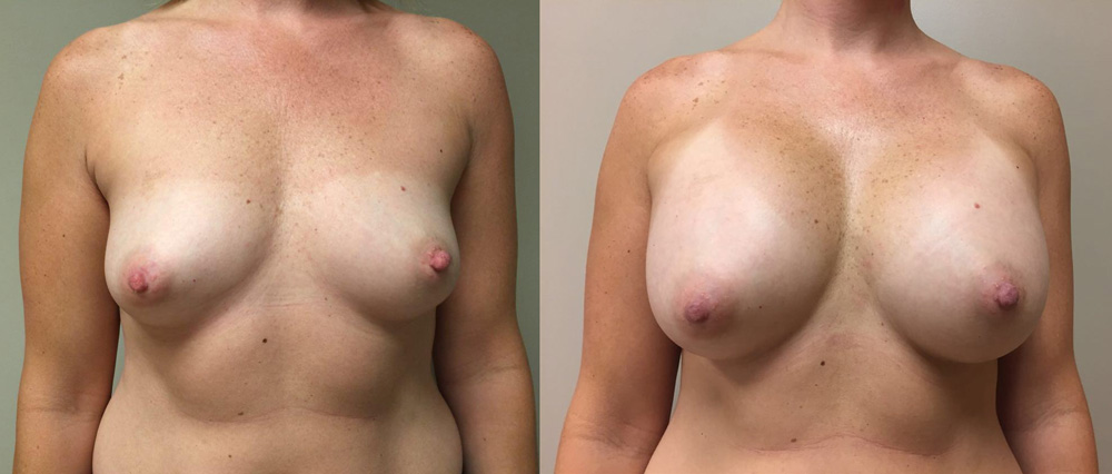 Breast Augmentation Patient 25 | Dr. Shaun Parson Plastic Surgery Scottsdale Arizona