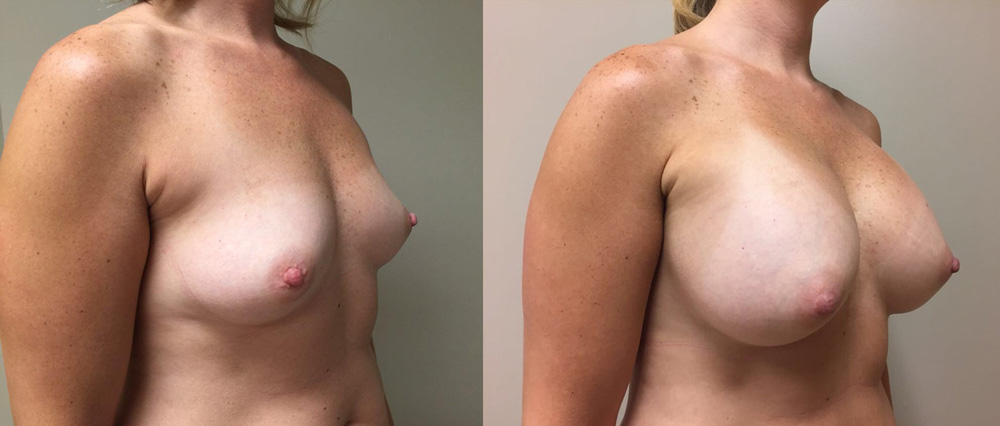Breast Augmentation Patient 25 | Dr. Shaun Parson Plastic Surgery Scottsdale Arizona